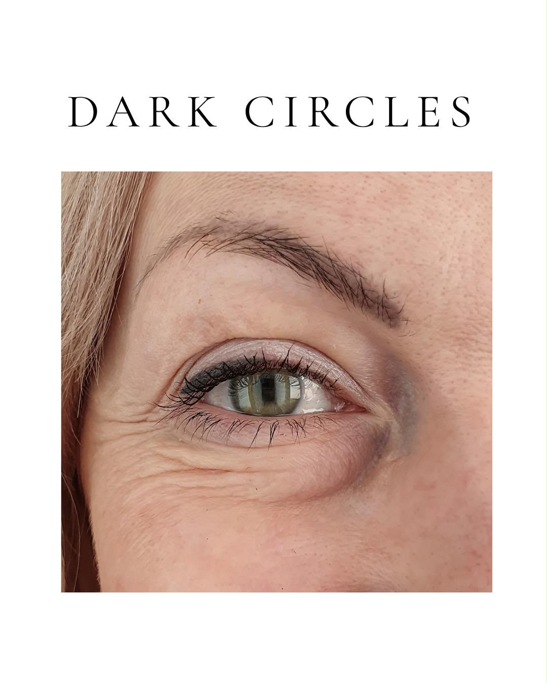 Dark Circles