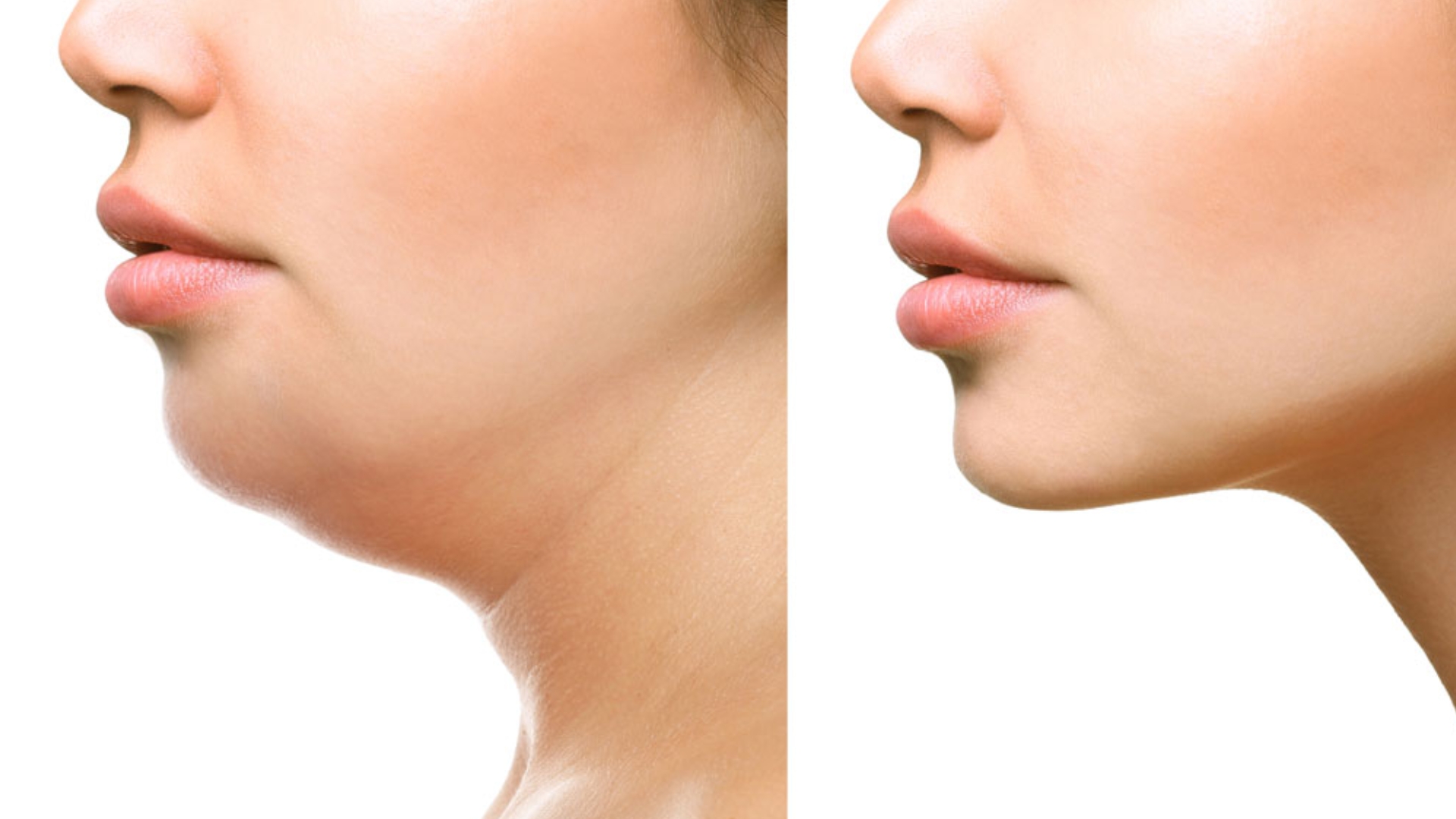 Facial Slimming