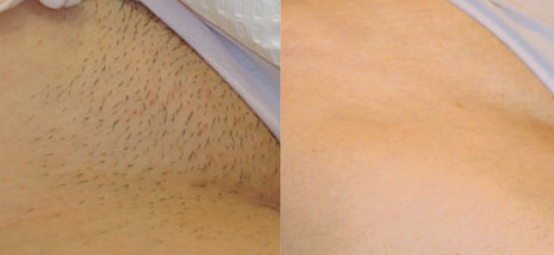 Hair Removal