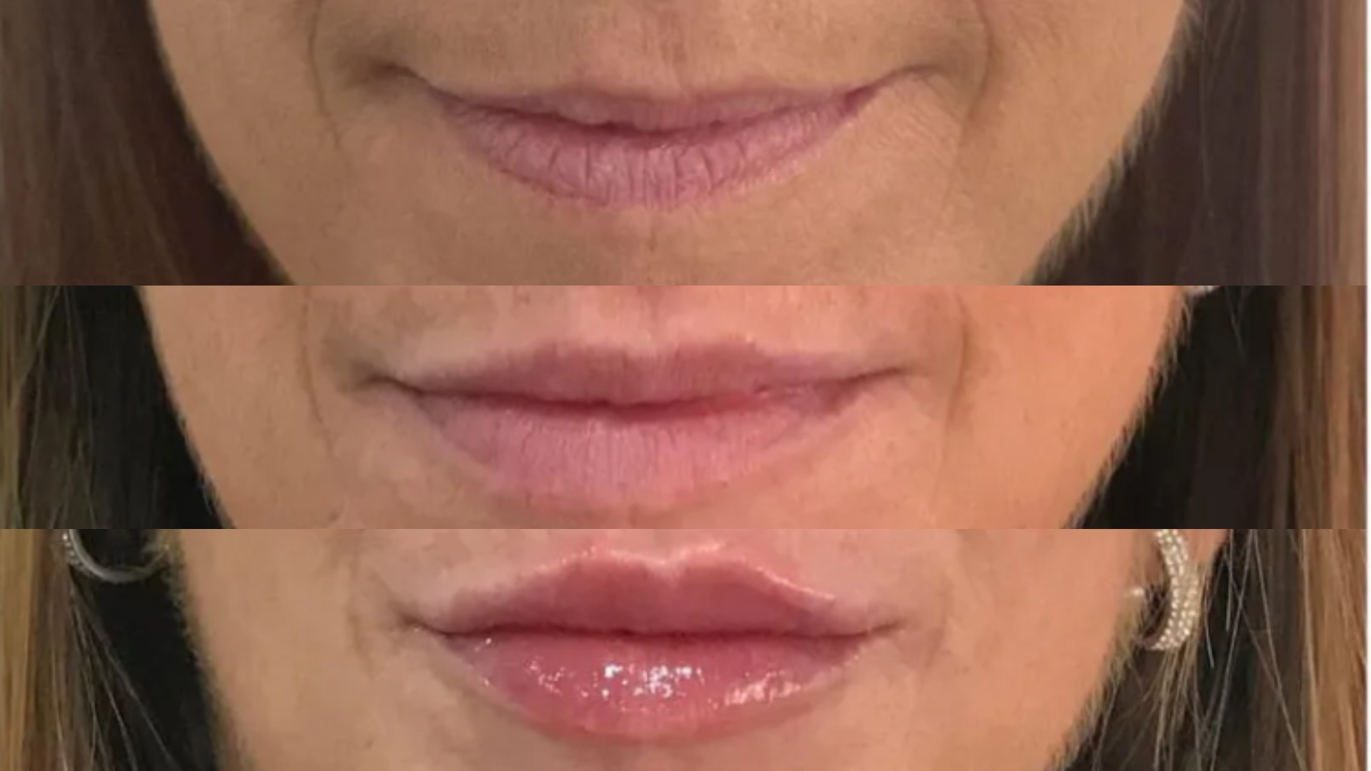 Lip Concerns