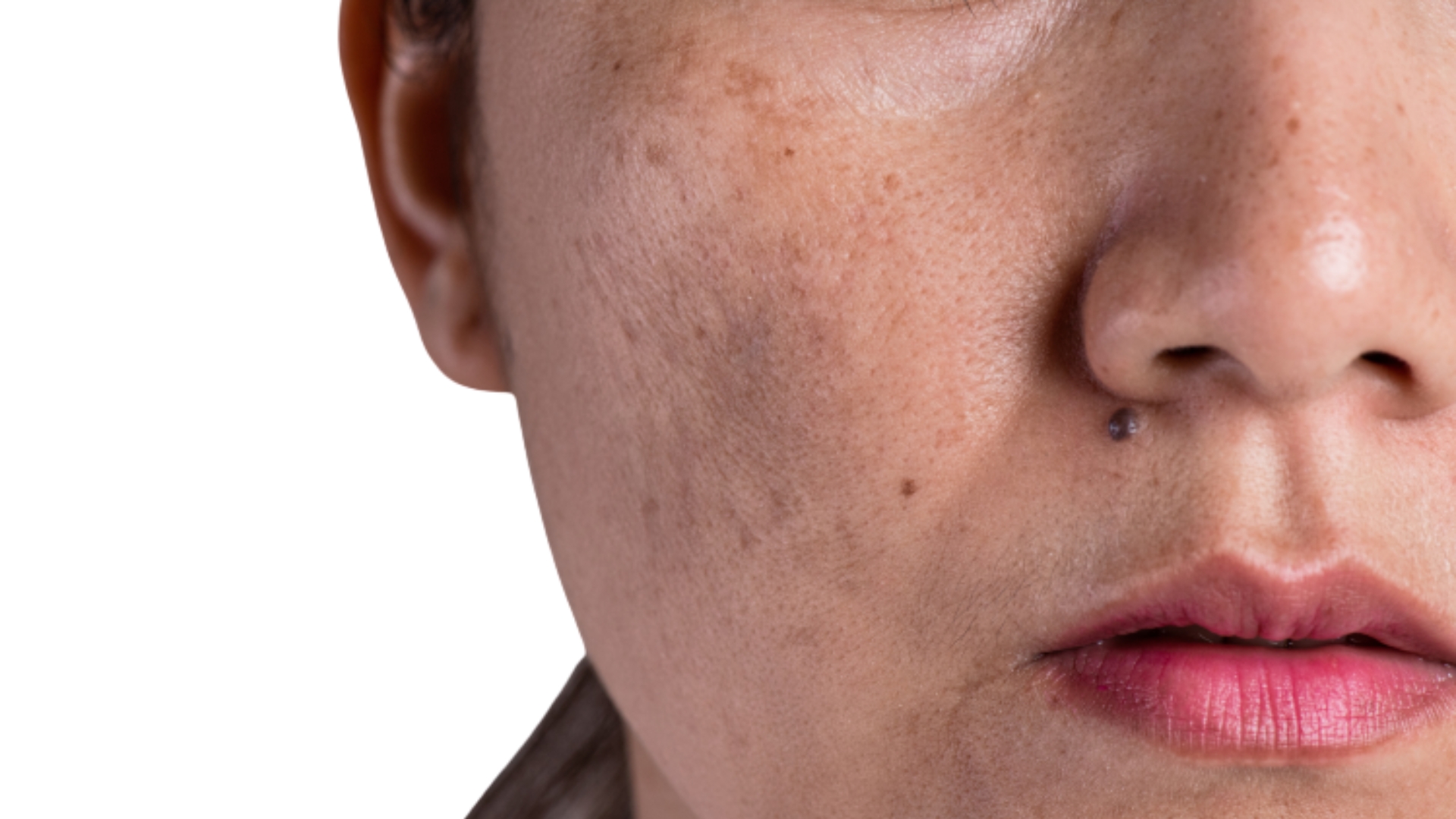 Pigmentation