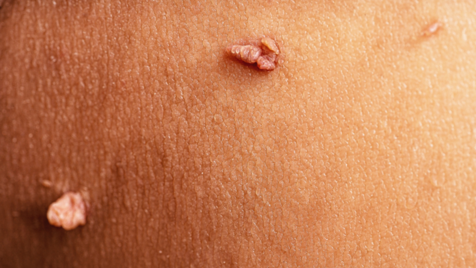 Skin Tags