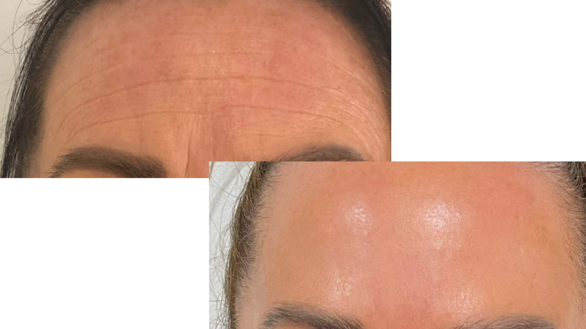 Fine Lines & Wrinkles