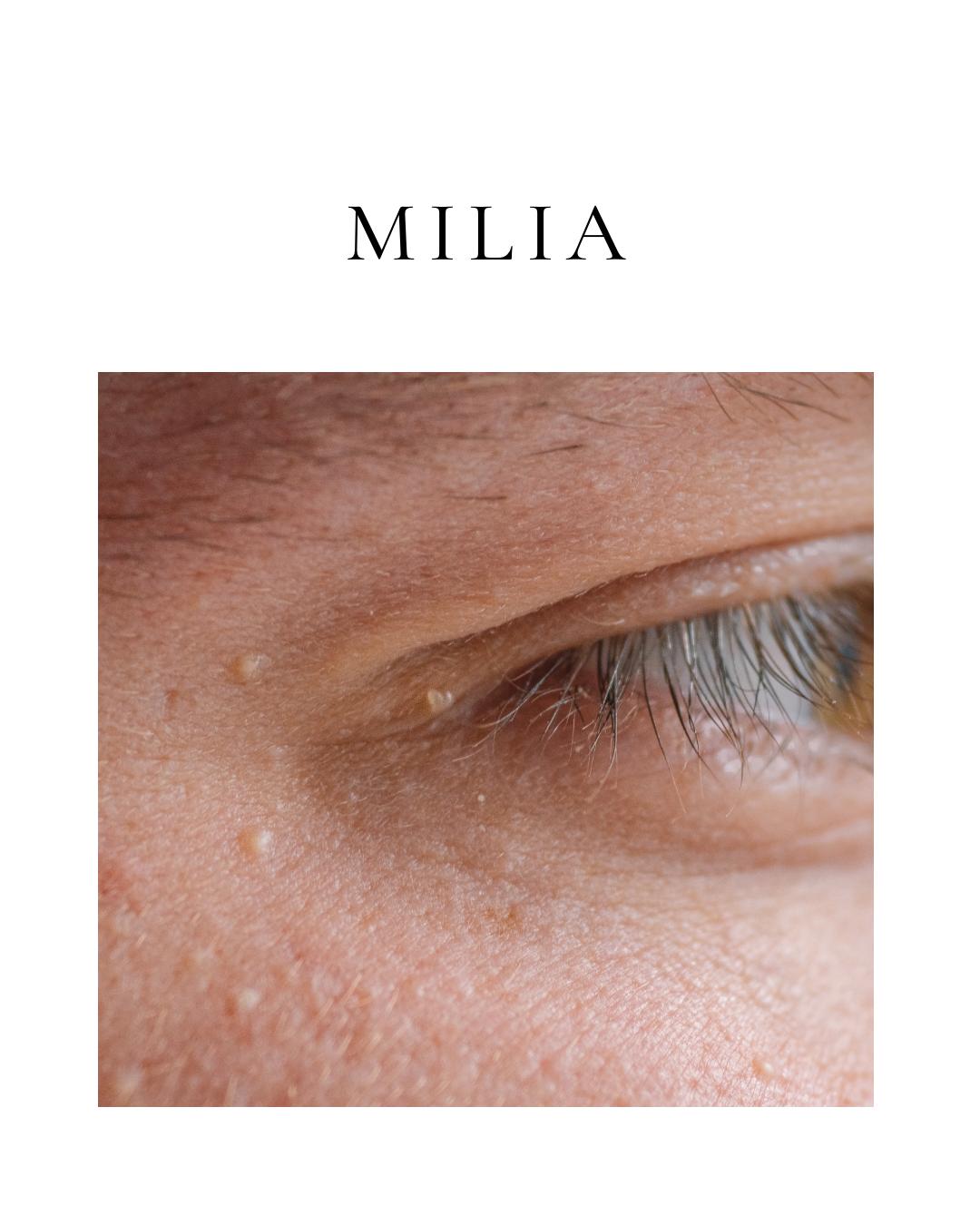 Milia