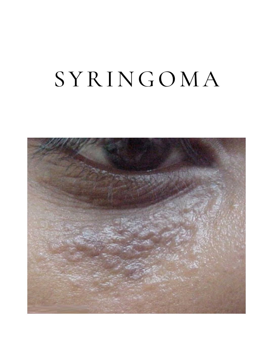 Syringoma