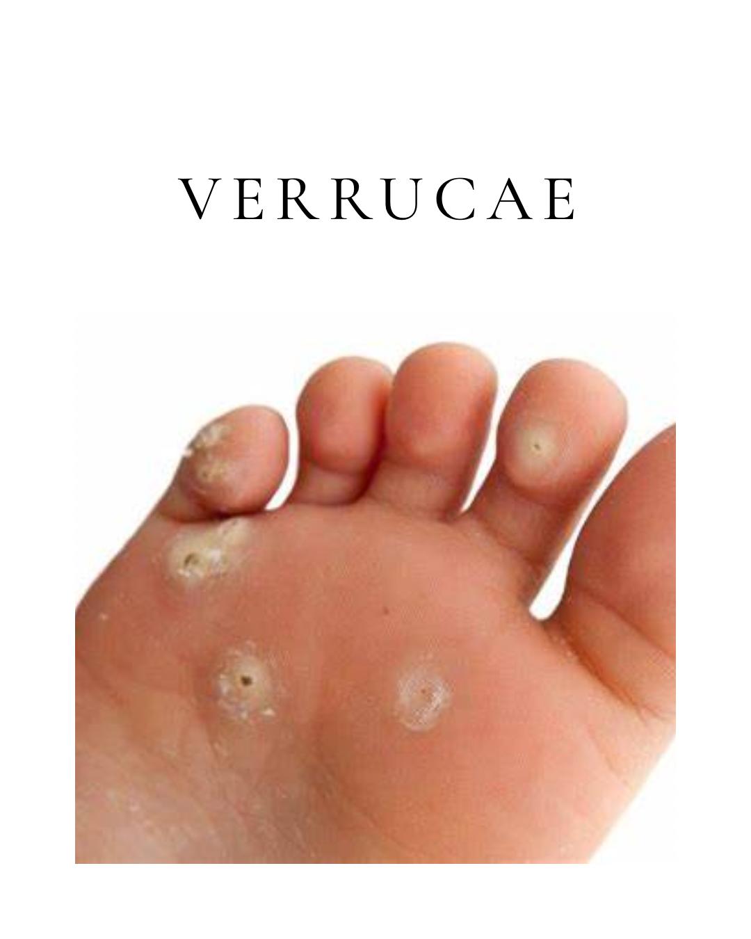Plantar Warts (Verruca)