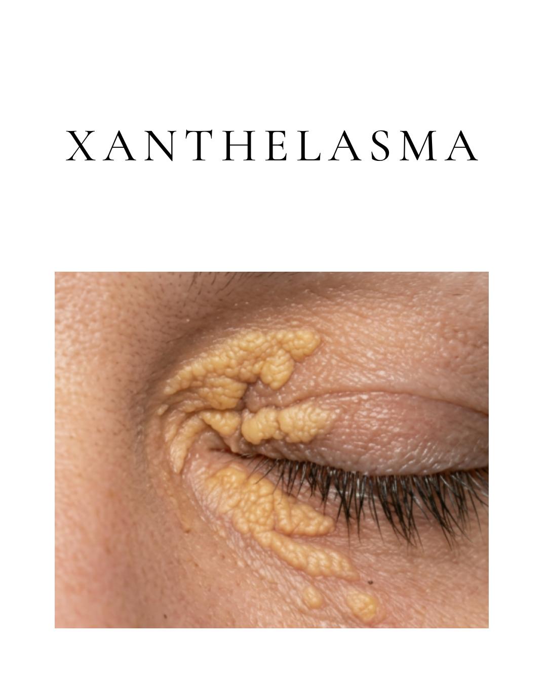 Xanthelasma
