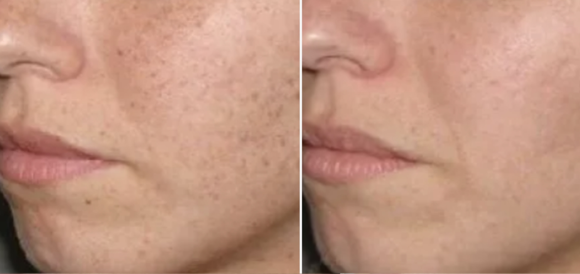 Blemish Removal
