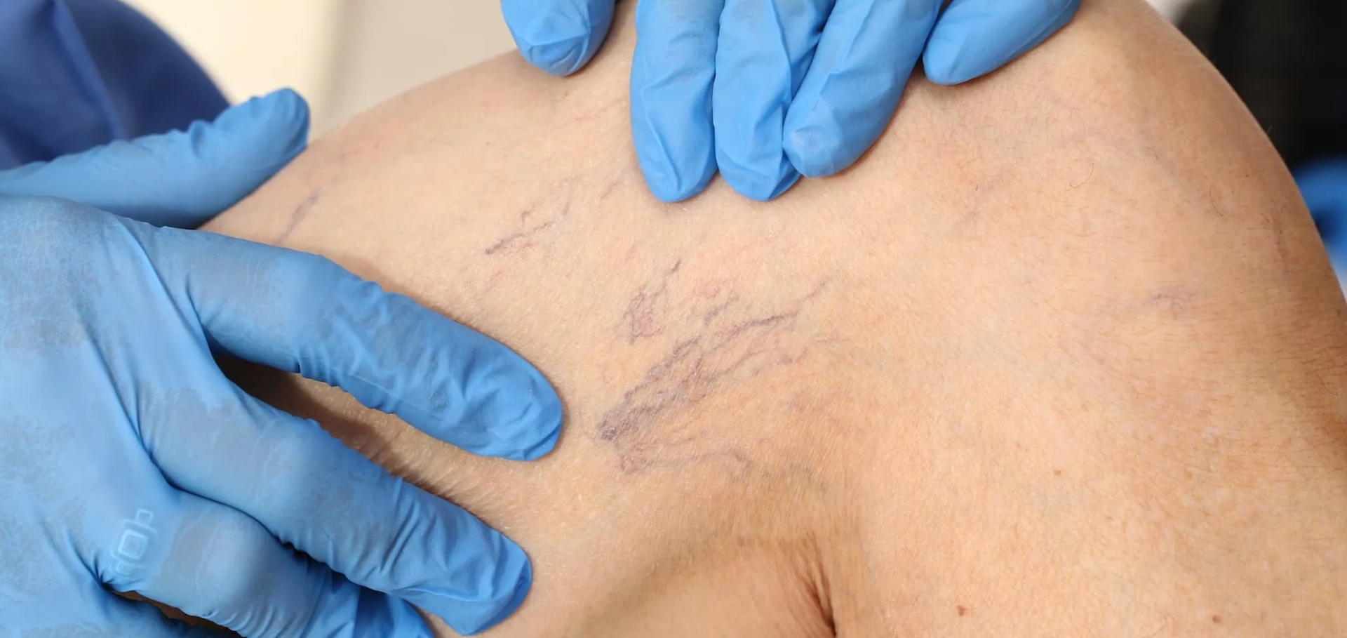 Microsclerotherapy